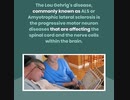 Amyotrophic Lateral Sclerosis or (ALS)