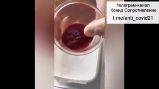 【コロナワクチン】ワクチン接種者の血液の状態