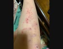 不都合起きてる　ワクチン無料、ワクチン被害治療費は自己負担