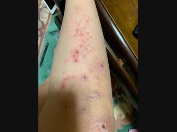 不都合起きてる　ワクチン無料、ワクチン被害治療費は自己負担