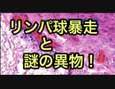 遺体解剖して分かったワクチン接種後のリンパ球暴走、ワクチン液内の得体のしれない異物！