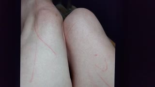 足に長い傷をレーザー(？)で付けられた❗️