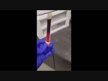 ワクチン接種した人の血液を採血管にいれると３分で凝固してしまう証拠映像（通常の血液は30分で固まる）