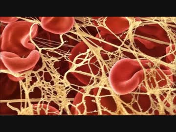 ワクチン接種者の遺体から、(ヘチマのような)白く強力な繊維状の血栓が発見される事例が急増している