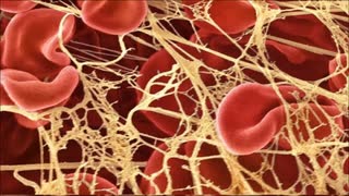 ワクチン接種者の遺体から、(ヘチマのような)白く強力な繊維状の血栓が発見される事例が急増している