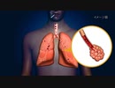 COPD（慢性閉塞性肺疾患）を知る～あなたの肺、おいくつですか？～-720p