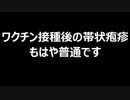 ワクチン接種後の帯状疱疹　もはや普通です