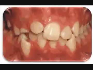 ホモと見る　歯並びってここまで矯正できるのか