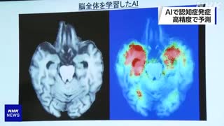 AIで解析 認知症発症を高精度で予測 富士フイルムなど _