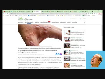 帯状疱疹＝サル痘＝天然痘＝VAIDS＝コロナワクチン薬害　なのか？豪クイーンズランド保険局HPで考える