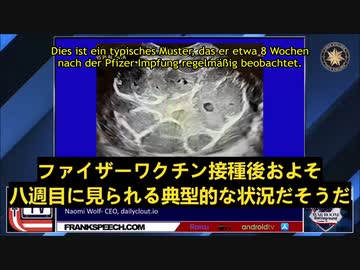 ワクチンを打っていた妊婦の胎児の状態 (日本語とドイツ語の字幕)