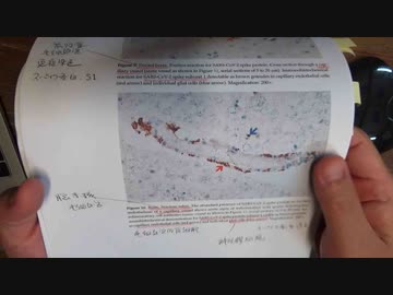 YouTubeアカバン前の重要動画「アレの症例報告論文(多巣性壊死性脳炎）」