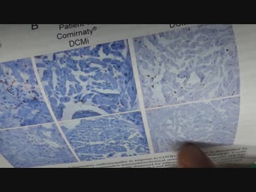 YouTubeアカバン前の重要動画「ワクチン後心筋炎の病理学論文」