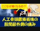 大腿骨頸部骨折術後の股関節外側部の痛みの原因は〇〇！最小侵襲進行関節手術の術後の皮膚、筋、神経の影響について解説