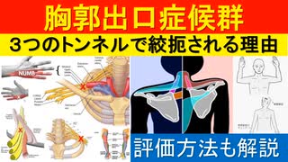 胸郭出口症候群は３つのトンネルで血管が圧迫されます！そのトンネルとはどこ？臨床で使える評価方法も解説します！