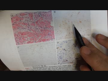 ワクチン後症候群の症例報告論文（長崎大学）