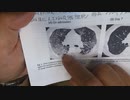 ワクチン後間質性肺炎の症例報告論文（東京済生会中央病院）