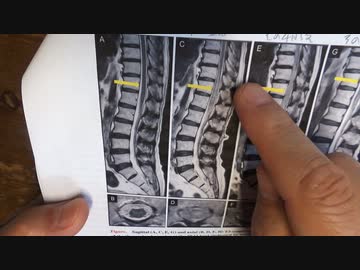 ワクチン後症候群の症例報告論文（愛媛大学）