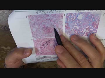 ワクチン後症候群の症例報告論文（東京都立墨東病院）