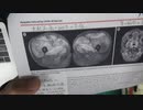 ワクチン後症候群の症例報告論文（炎症性筋炎）