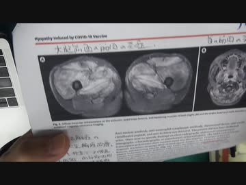 ワクチン後症候群の症例報告論文（炎症性筋炎）