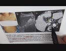 ワクチン後症候群の症例報告論文（札幌しらかば台病院）