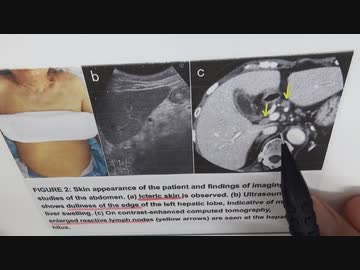 ワクチン後症候群の症例報告論文（札幌しらかば台病院）
