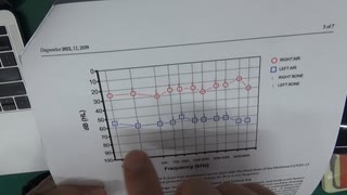 ワクチン後症候群の症例報告論文（突発性難聴）