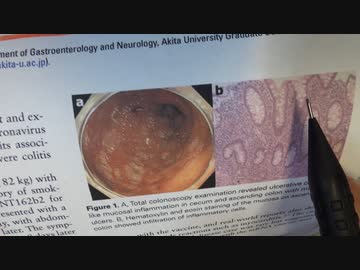 ワクチン後症候群の症例報告論文（秋田大学）