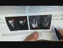 ワクチン後症候群の症例報告論文（聖隷浜松病院）