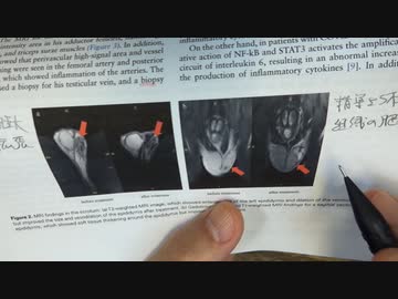 ワクチン後症候群の症例報告論文（聖隷浜松病院）