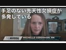 ファイザー社元副社長マイク・イェードン博士爆弾情報炸裂！　手足のない先天性欠損症が多発している