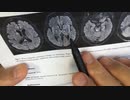 ワクチン後症候群の症例報告論文（和歌山県立医科大学２）