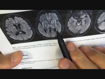 ワクチン後症候群の症例報告論文（和歌山県立医科大学２）