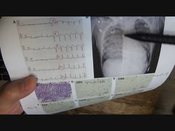 ワクチン後症候群の症例報告論文（名古屋大学）