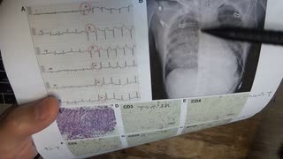 ワクチン後症候群の症例報告論文（名古屋大学）