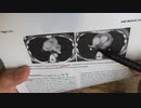 ワクチン後症候群の症例報告論文（高崎総合医療センター）