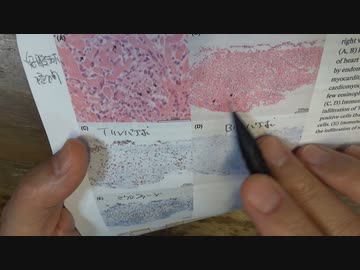 ワクチン後症候群の症例報告論文（香川県立中央病院）