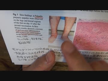 ワクチン後症候群の症例報告論文（大阪市立大学２）