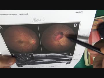 ワクチン後症候群の症例報告論文（長崎大学２）