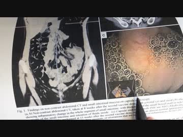 ワクチン後症候群の症例報告論文（東北大学２）