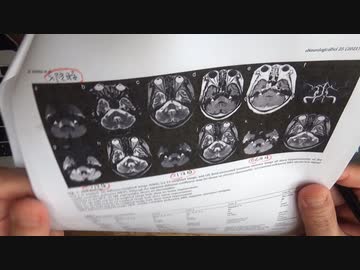 ワクチン後症候群の症例報告論文（順天堂大学浦安病院）