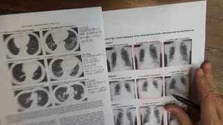 ワクチン後症候群の症例報告論文（金沢大学）