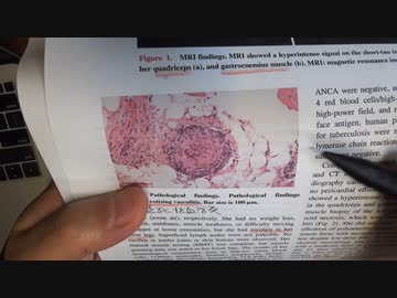 ワクチン後症候群の症例報告論文（聖隷浜松病院２）