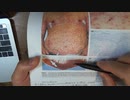 ワクチン後症候群の症例報告論文（鹿児島市立病院）
