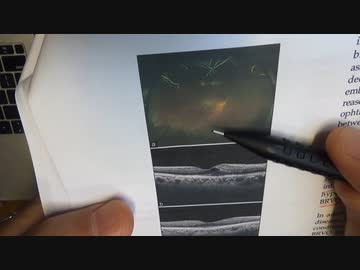 ワクチン後症候群の症例報告論文（ツカザキ病院）