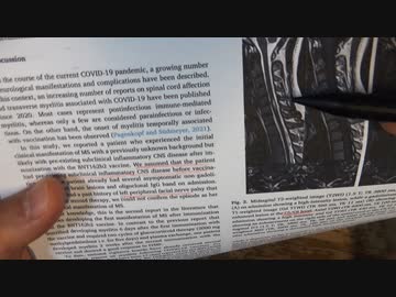 ワクチン後症候群の症例報告論文（東北医科薬科大学）