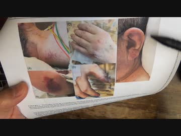 ワクチン後間質性肺炎の症例報告論文（東京済生会中央病院２）