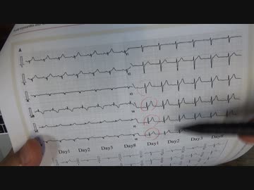 ワクチン後症候群の症例報告論文（東近江総合医療センター）