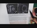 ワクチン後症候群の症例報告論文（JCHO大阪病院）